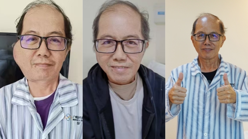 Lymphoma Patient from Malaysia Yoo khee Chai Before and After Treatment