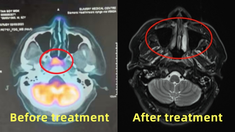 Nasopharyngeal Carcinoma Patient from Malaysia Tan Soy Mok Before and After Treatment