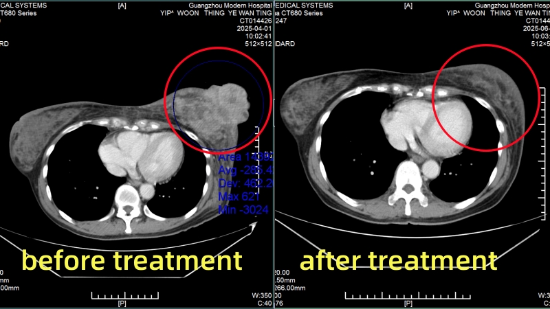 Breast Cancer Patient from Malaysia Yip Woon Thing Before and After Treatment